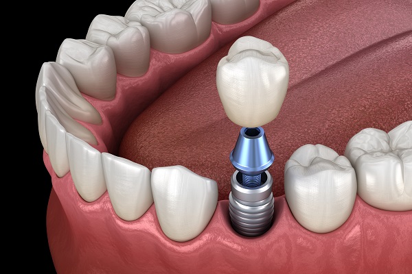 Common Questions And Answers About Implant Supported Dentures