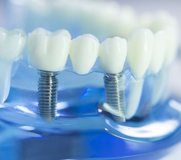 Berkley Dental Implants