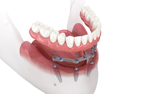 Comparing Implant Supported Dentures With Traditional Dentures